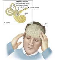 Bài thuốc chữa rối loạn tiền đình hiệu quả nhất