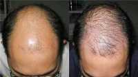 Chữa rụng tóc, mọc tóc nhanh và đen